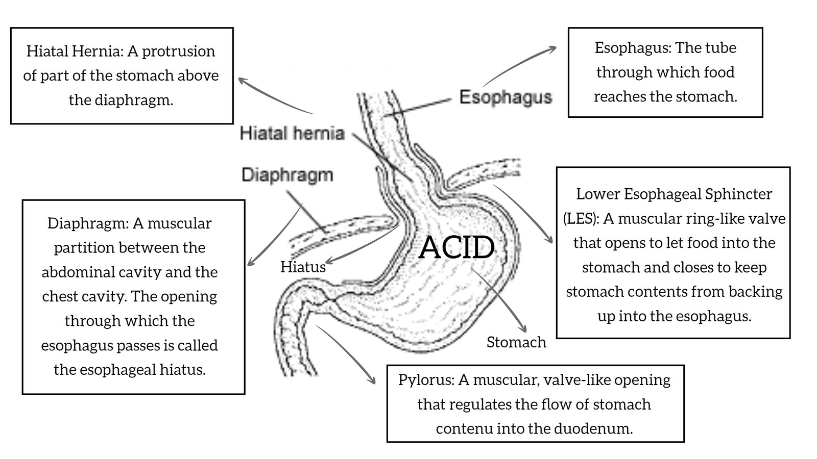 Hiatal hernia Diagnosis and treatment